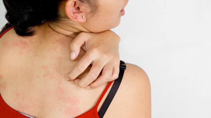 Your Diet May be Affecting Your Eczema