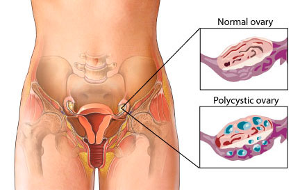 Polycystic Ovarian Syndrome