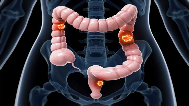 Turning up the Heat on Colorectal Cancer
